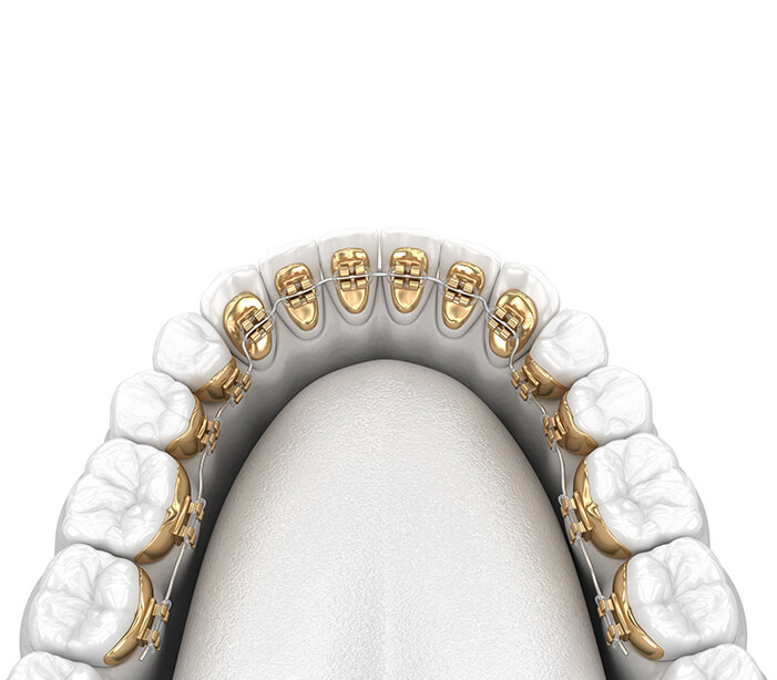 Incognito lingual
braces