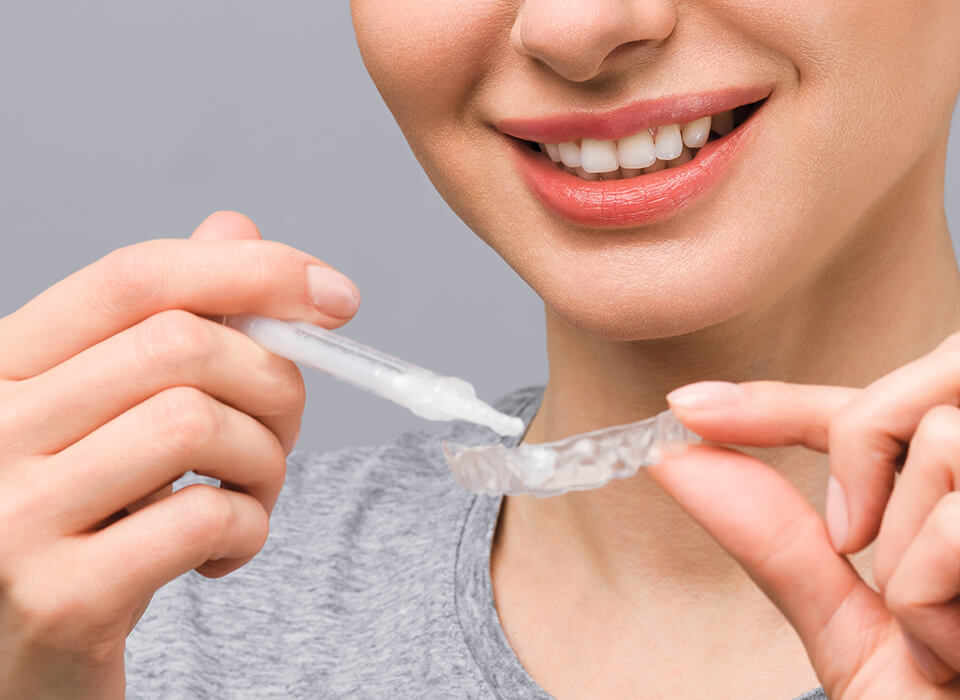 How long do teeth whitening
results last?