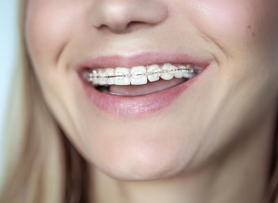 What are
clear braces?