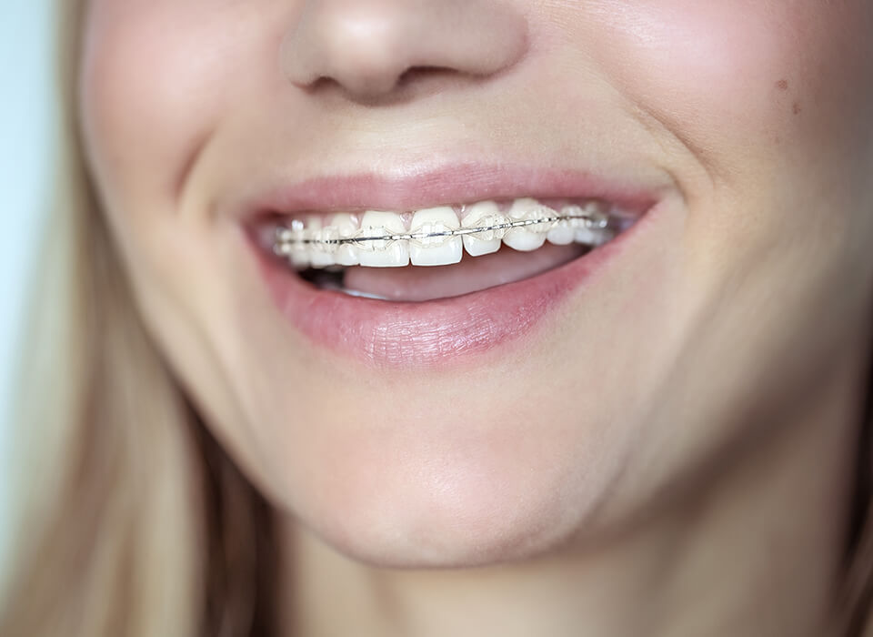 What are
clear braces?