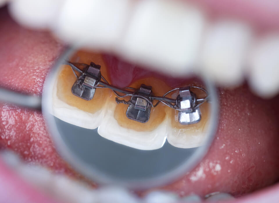 What are lingual
braces?