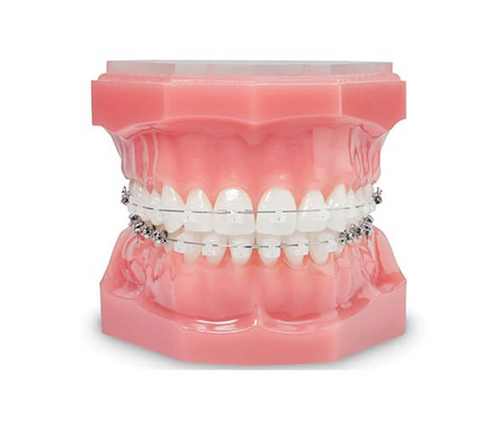 Radiance™ ADVANCED braces